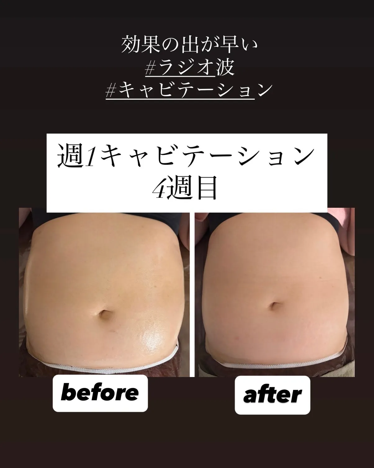 【効果を実感したい方へ】キャビテーション×ラジオ波で理想のボディへ✨